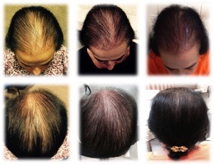 Treatment of androgenetic alopecia - Regenera Activa 03