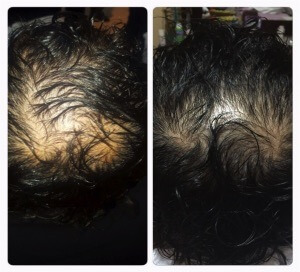 Treatment of androgenetic alopecia - Regenera Activa 04