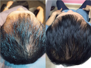 Treatment of androgenetic alopecia - Regenera Activa 05