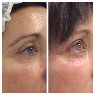 Non-surgical eyelid lifting - zabieg1