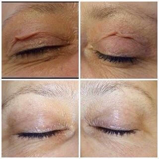 Non-surgical eyelid lifting - zabieg2