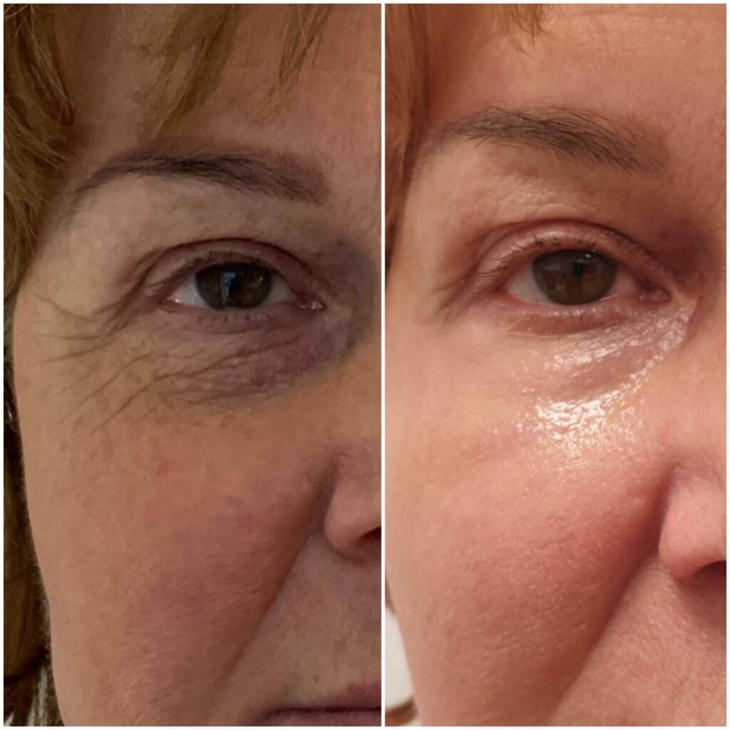 Non-surgical eyelid lifting - image0