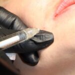 Needle mesotherapy of the face - IMGwlasciwy
