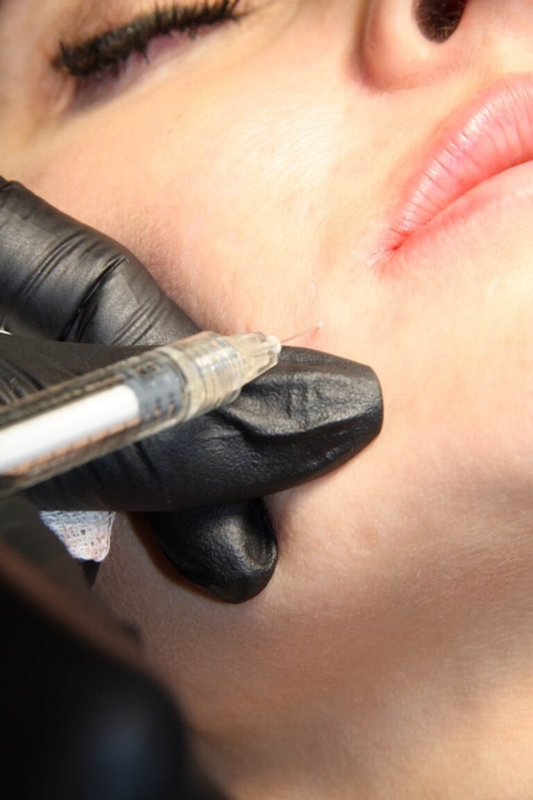 Needle mesotherapy of the face - IMGwlasciwy