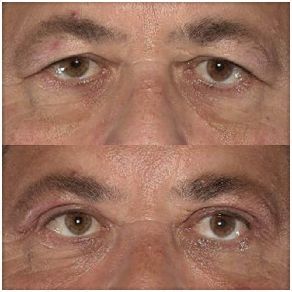 Surgical correction of bottom and upper eyelids - korekta powiek
